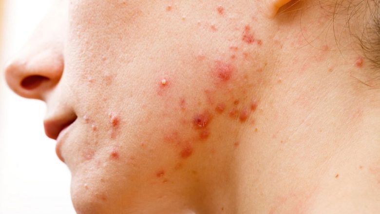 acne spots
